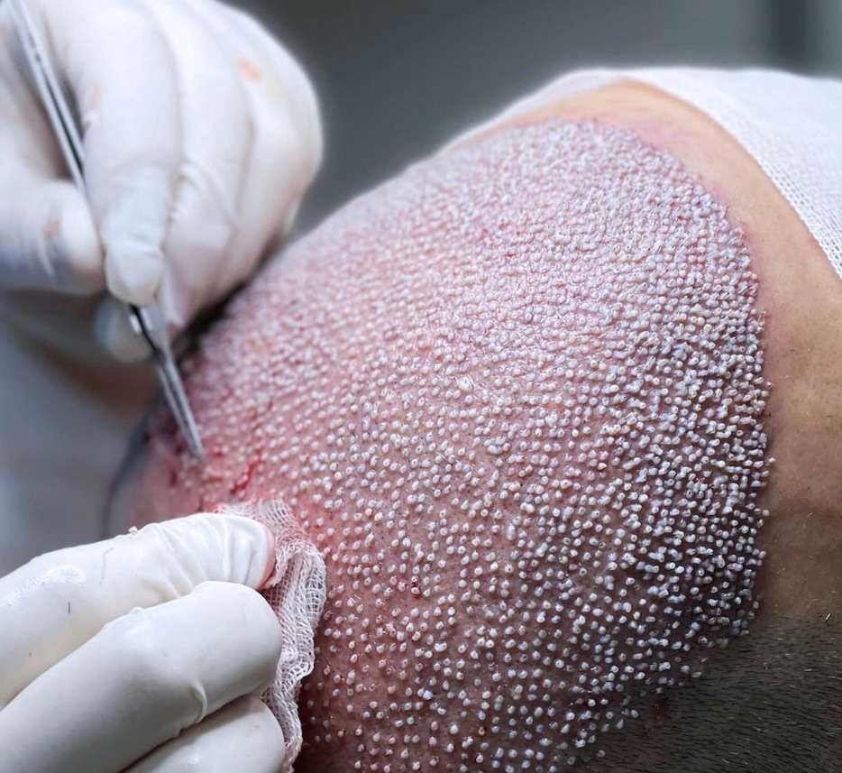 Dmhairtransplant